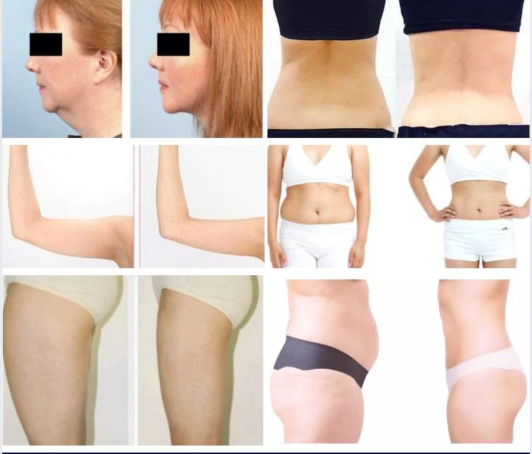 Fat Dissolved Mesotherapy Cocktail Lipolytic Solution Injectable 5ml Weight Reduction Body Slimming